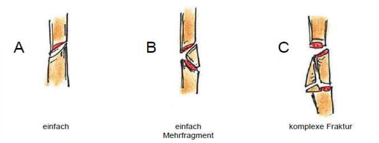 <p>A: einfach</p><p>B: einfach Mehrfragment</p><p>C: komplexe Fraktur</p>