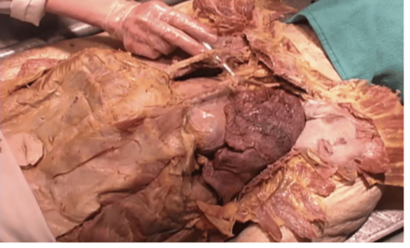 <p>What are these under the pointer?</p><p>Internal renal arteries and veins</p><p>Internal carotid arteries and veins</p><p>Internal thoracic arteries and veins</p><p>Internal subclavian arteries and veins</p>