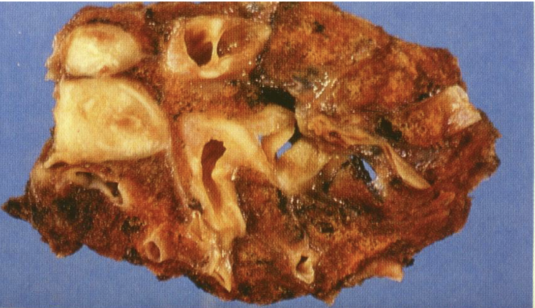 <p>low-grade, malignant neuroendocrine neoplasm of the lung; low mitotic activity, no necrosis;  peribronchial location of tumor very common; very high 5 year survival rate</p>