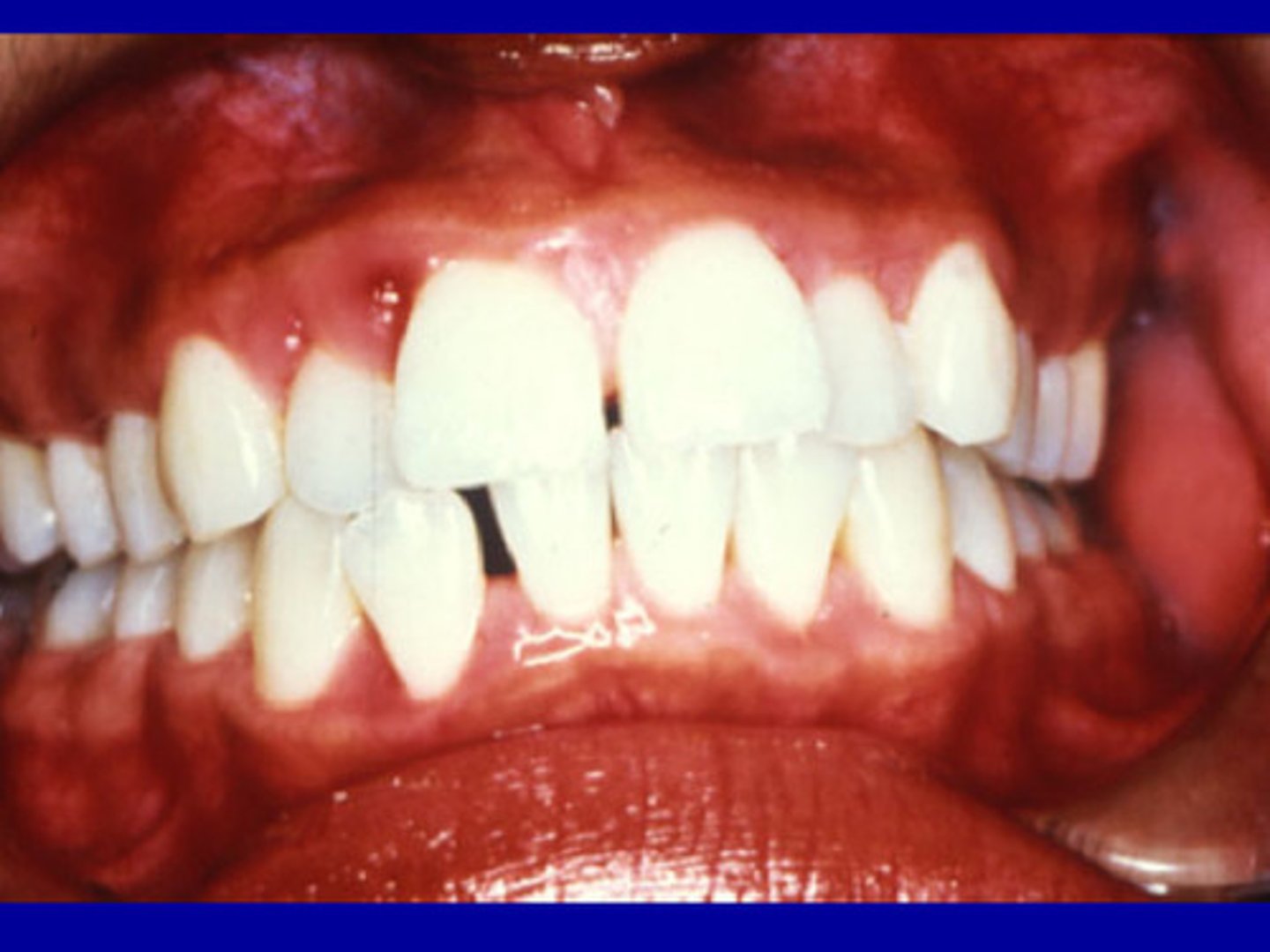 <p>Increased hormone levels in gingival crevicular fluid associated with dramatic increases in P. intermedia, which use hormones as growth factors.</p>