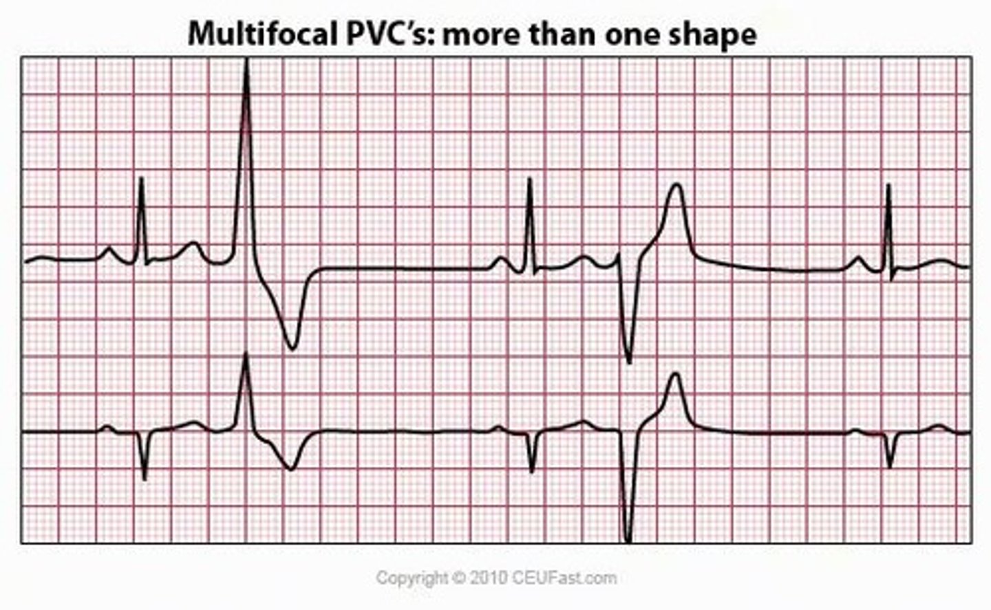 <p>every second beat PVC</p>