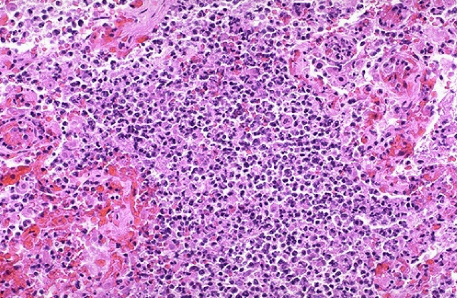 <ol><li><p>Abscess</p></li><li><p>Alveolar walls are no longer visible; adjacent hemorrhage</p></li></ol><p></p><p>More virulent bacterial organisms or more severe inflammation with pneumonia can be associated with destruction of lung tissue and hemorrhage.</p><p></p>