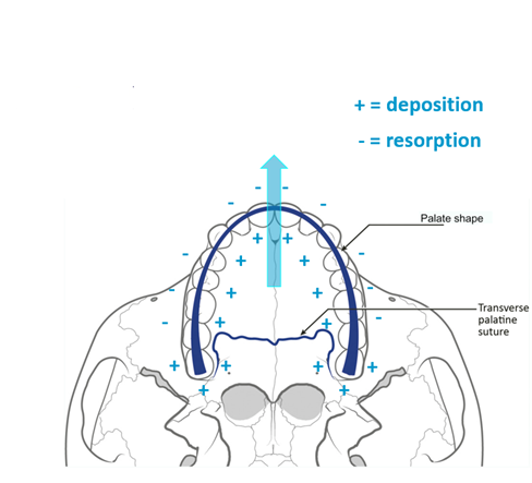 <p>Arrow in pic shows direction of growth</p><ul><li><p>deposition = on the palate and rapid on the tuberosities</p></li><li><p>resorption = labial area</p></li></ul><p></p><p>Deposition posteriorly is greater than resorption anteriorly = forward growth</p>