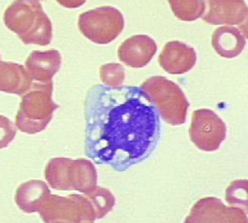 <p> “holes” in the cytoplasm; frequently seen in association with toxic granules</p><ul><li><p><strong>Commonly seen in acute infections – usually bacterial.</strong></p></li></ul><p></p>