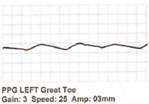 <p>What term best describes this digital PPG waveform:</p>