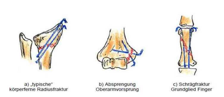 <p>Operative Frakturbehandlung </p><p><strong> Kirschnerdraht-Osteosynthese </strong></p><ul><li><p>kleines Loch</p></li><li><p>manipulation zur besseren einrichtung</p></li><li><p>erneutes bohren möglich</p></li></ul><p></p>