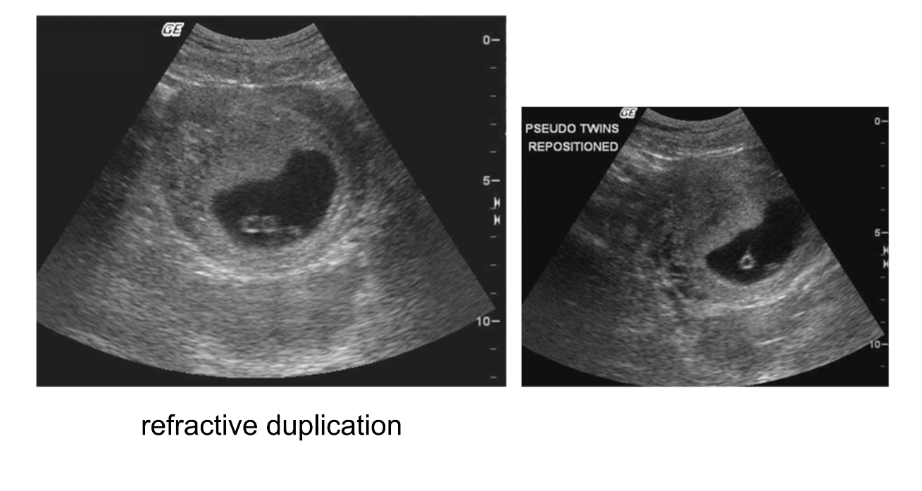 <p>Where there is lateral duplication of the interface on either side of its true location.</p>