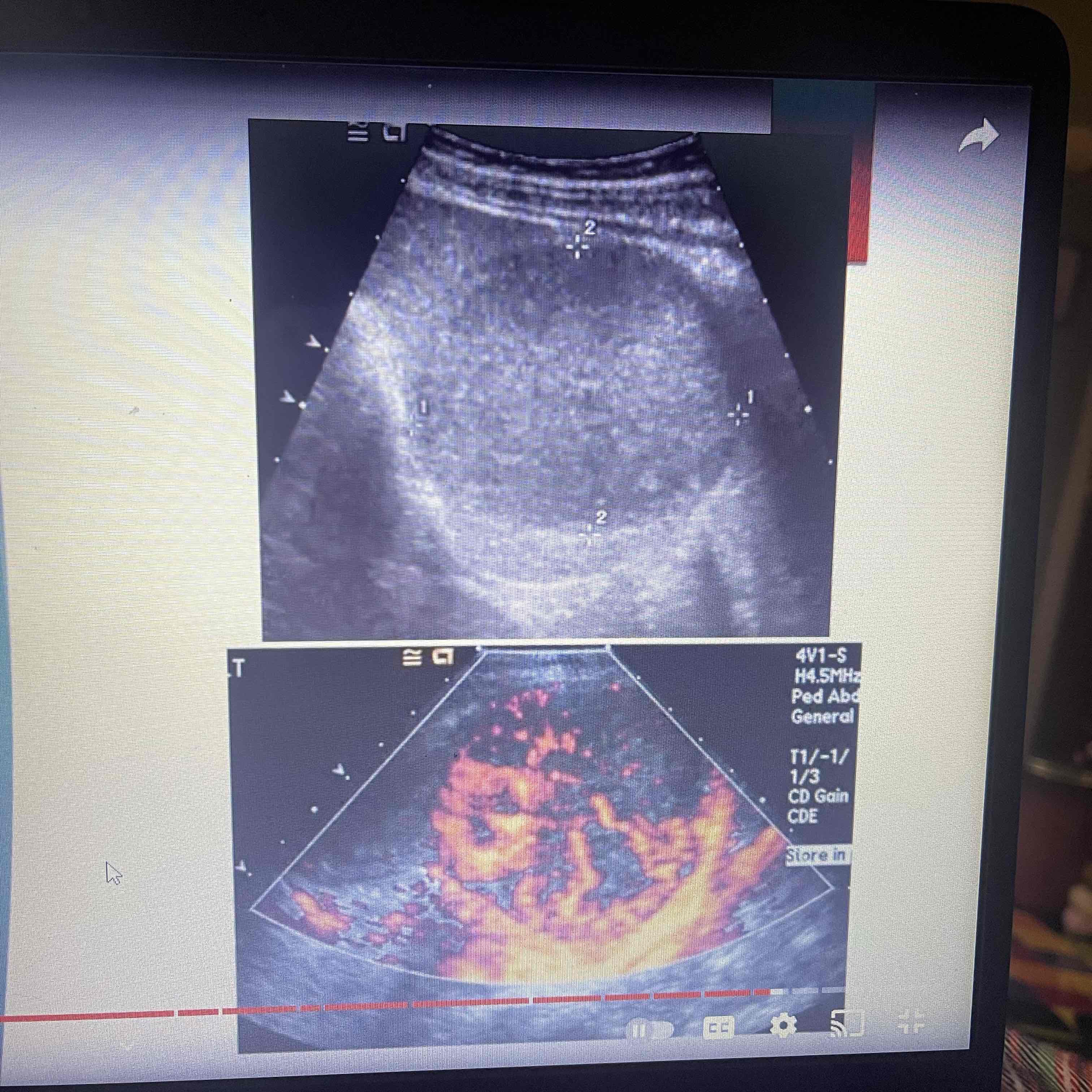 <ul><li><p>Abnormal mixture of cells and tissues: Mainly lymphoid tissues</p></li><li><p>Rare, Benign</p></li><li><p>Clinically: Asymptomatic</p></li><li><p>Sonographic: Cystic and solid components, isoechoic / hyperechoic</p></li></ul>