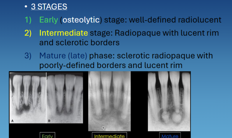 <ul><li><p>early → RL </p></li><li><p>intermediate → RO w RL rim and sclerotic borders </p></li><li><p>mature/late phase → sclerotic RO w RL rim </p></li></ul><p></p>