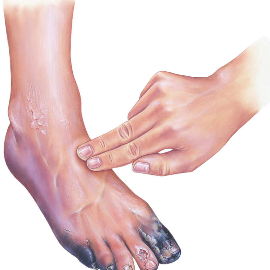 <p><span style="line-height: 107%;"><strong><span>BOOK:</span></strong></span></p><p class="MsoNormal"><span style="line-height: 107%;"><span>a condition in which there is an insufficient supply of oxygen in the tissues due to restricted blood flow to a part of the body.</span></span></p><p class="MsoNormal"><span style="line-height: 107%;"><strong><span>SIMPLE:</span></strong></span></p><p class="MsoNormal"><span style="line-height: 107%;"><span>Not enough blood getting to a body part.</span></span></p><p></p>