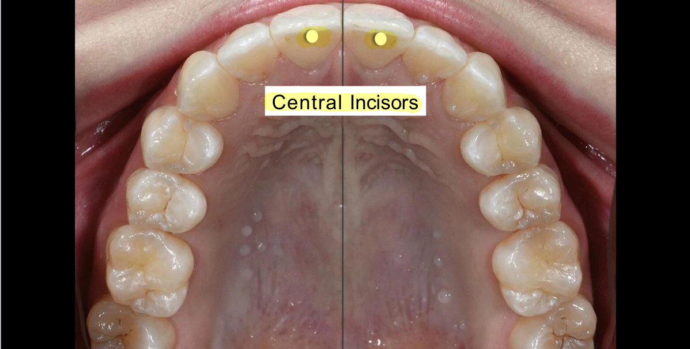 <p>Central Incisors</p>