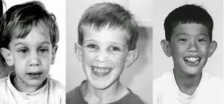 <p>Macrocefalia y cara alargada. Fisuras palpebrales estrechas. Frente prominente. Epicanto. Estrabismo. Orejas y mentón prominente. Prognatismo. Paladar ojival. Maloclusión denta</p>