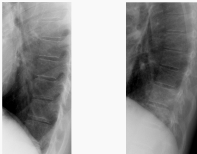<p>Which image represents the&nbsp;“spine sign” and what does this mean?</p>