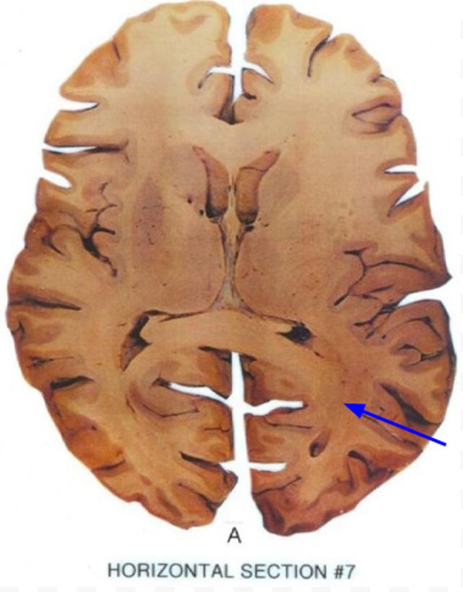 <p>white matter axons from the lateral geniculate nucleus that terminate in the primary visual areas of the occipital cortex</p>