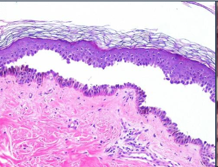 <p>Epithelial cell separation “INTRA-EPITHELIAL”</p>
