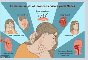 <p>Head & Neck infection is the <strong>commonest cause of enlargement</strong> </p><p>May also be the<strong> first sign of systemic disease:</strong></p><ul><li><p>with <strong>infection </strong>you tend to get <strong>bilateral </strong>enlargement of lymph nodes - <strong>tenderness </strong></p></li><li><p>with <strong>malignancies - unilateral </strong>and <strong>non tender</strong> </p></li></ul><p><em>Glandular Fever,Lymphomas (hodgkins / non-hodgkin) ,Leukaemias ,HIV infection (Seroconversaion illness, or advanced HIV disease), Metastatic disease (usually from drainage)</em></p>