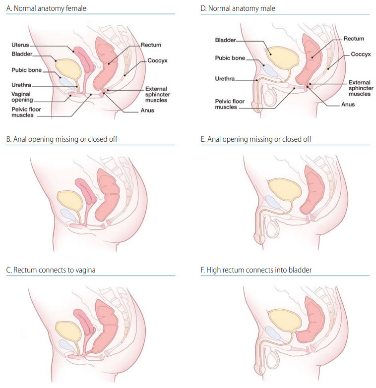 <p>Describes broad group of rare congenital conditions of lower intestinal tract (bowel). Atresia refers to a complete blockage while stenosis refers to a partial blockage.</p>