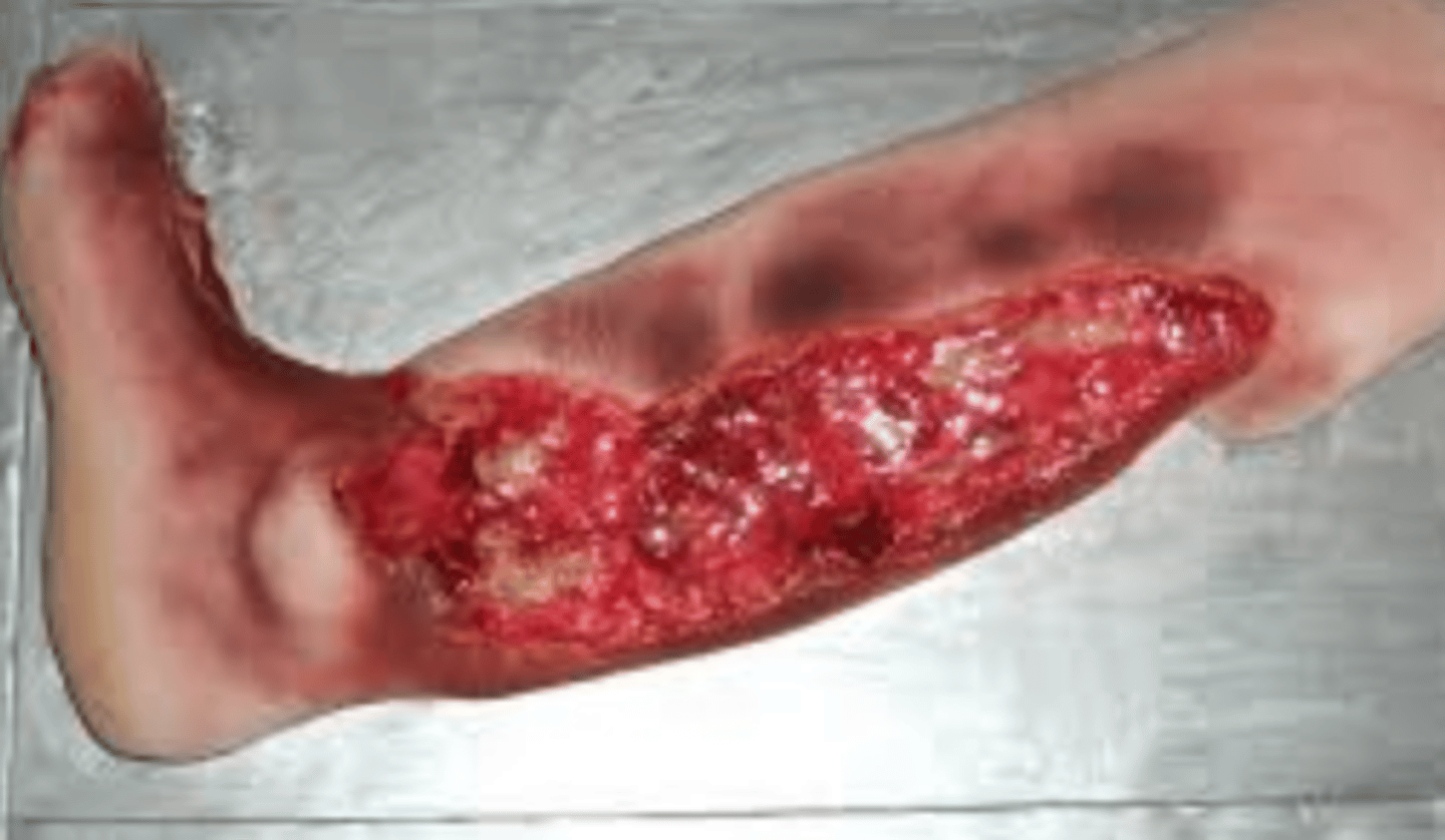 <p>Flesh eating disease caused by bacterial infection, often from Staphylococcus aureus or Streptococcus pyogenes </p>