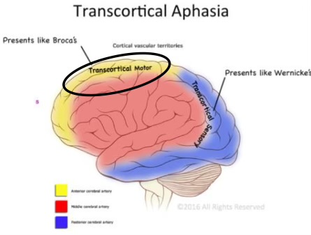 <p>fluent, doesn’t comprehend, repeats </p><p>auditory comprehension is relatively poor</p><p>repetition is intact  </p><p>fluent, well articulated speech</p><p>naming impaired</p><p>lesion: left posterior temporal- occipital lobe </p>