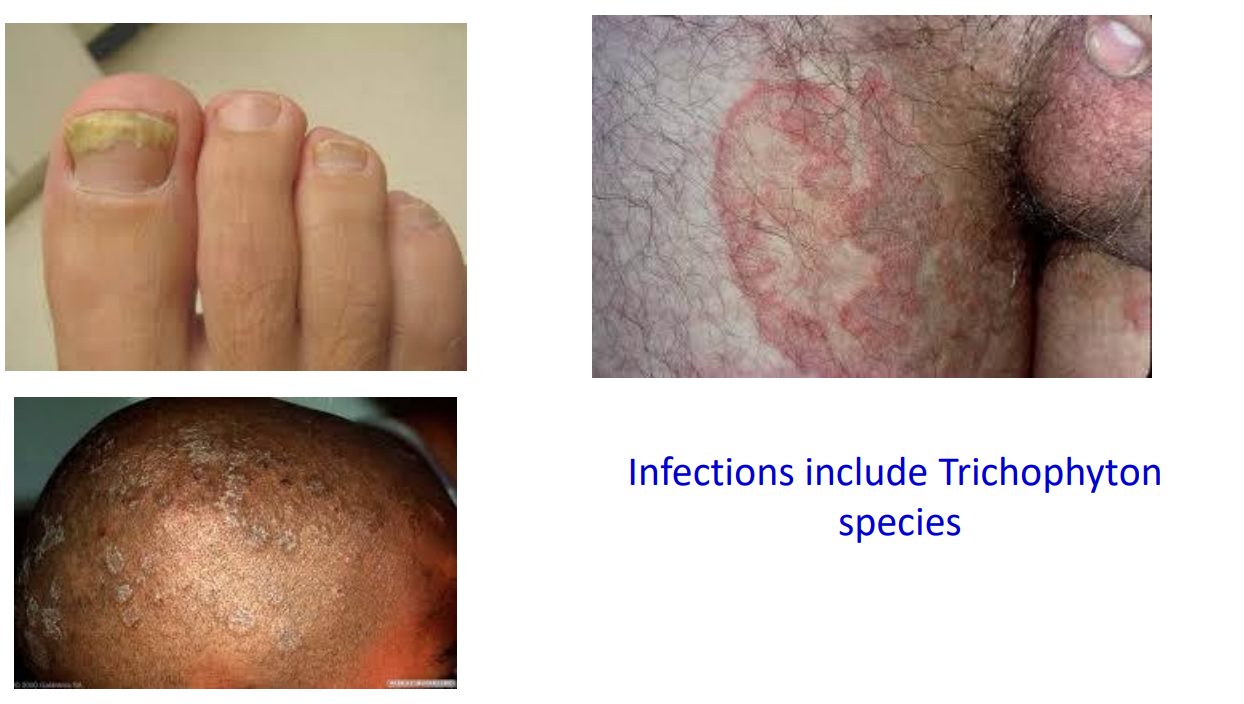 <p>Infections include Trichophyton species</p>