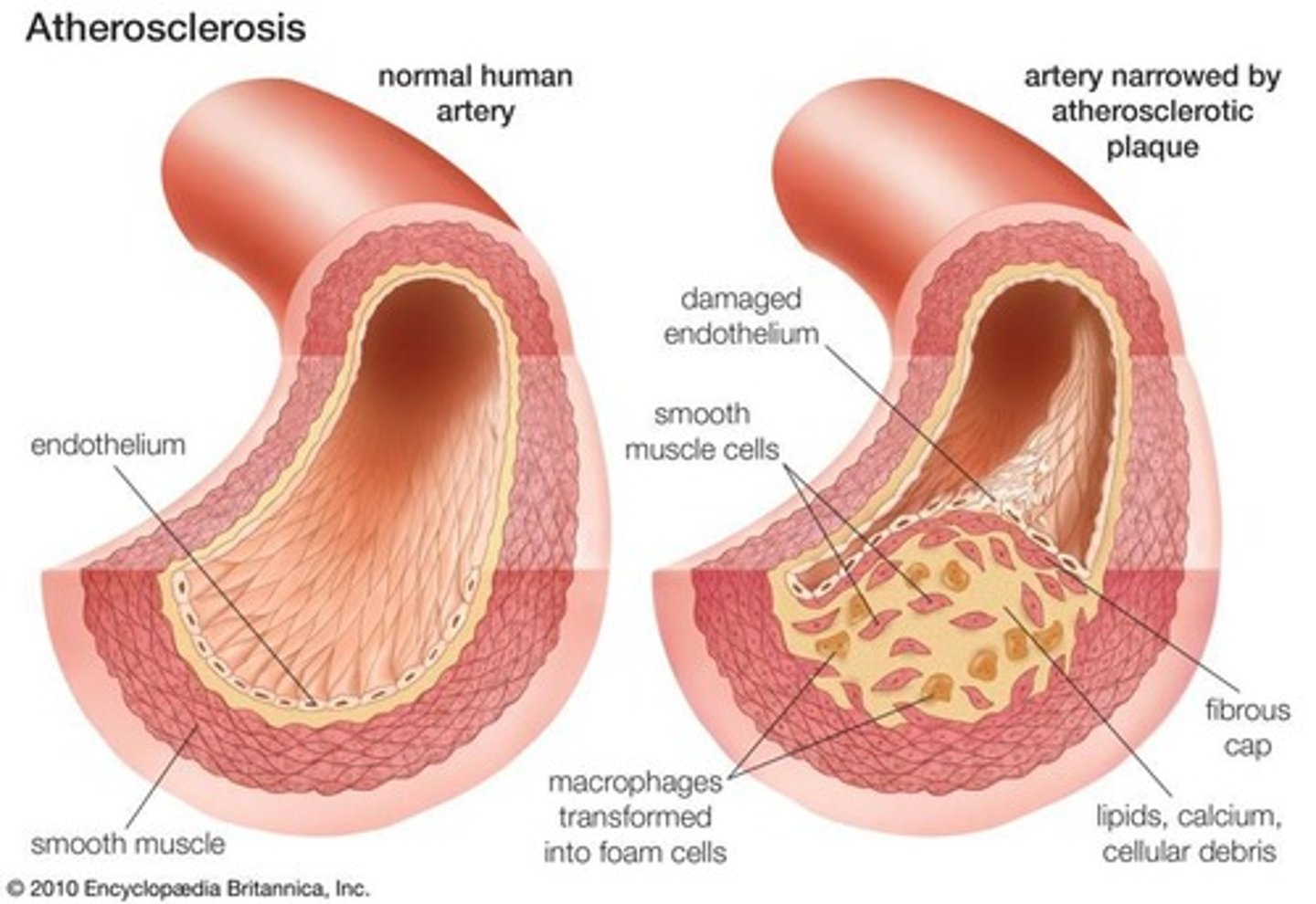 <p>Cause: High cholesterol, hypertension, smoking, diabetes. ECM Overproduction: Plaques contain excessive ECM proteins (collagen, elastin, proteoglycans) deposited by vascular smooth muscle cells. Calcification further stiffens arteries.</p>