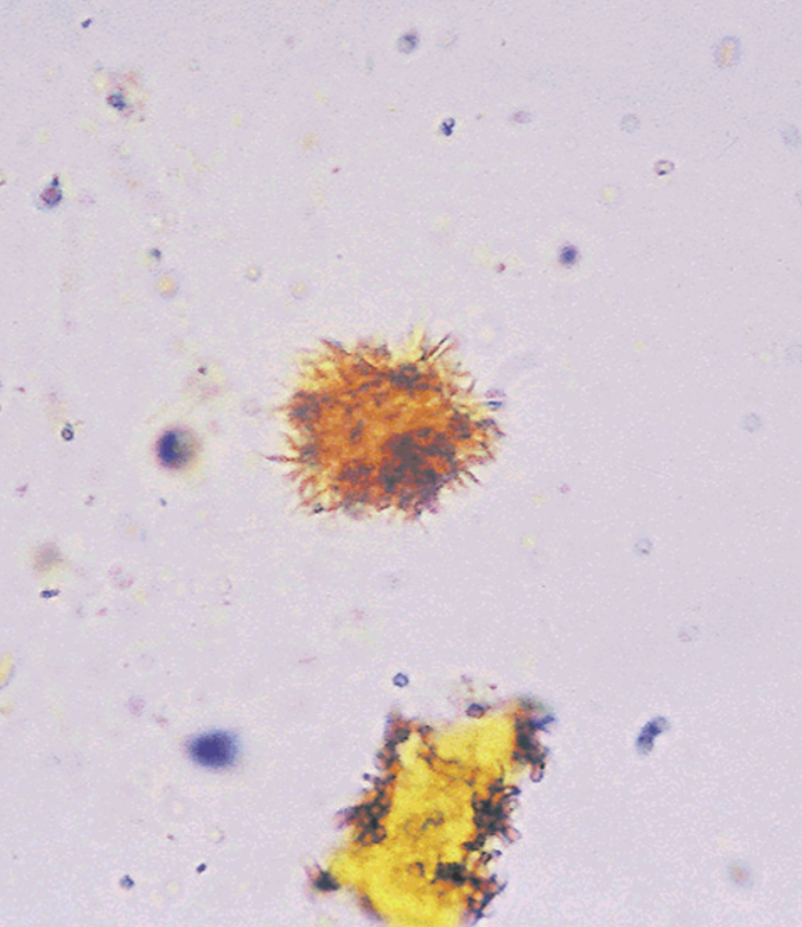 <p>Seen in patients with liver disorders</p>