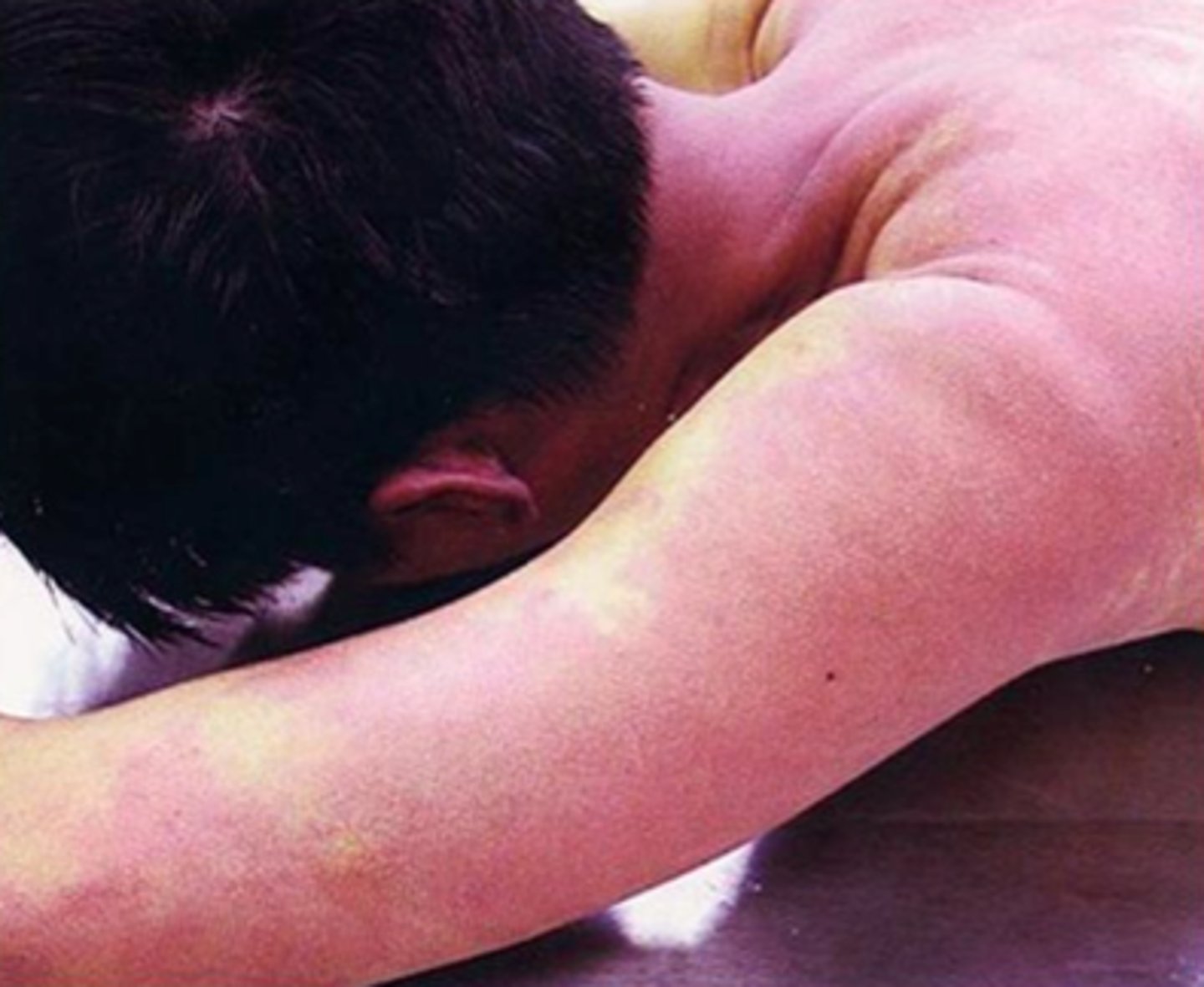 <p>• Cyanotic skin/mucous membranes</p><p>• Stupor</p><p>• Bradypnea</p><p>• Bradycardia</p><p>• Hypotension</p><p>• Cardiac dysrhythmias</p>