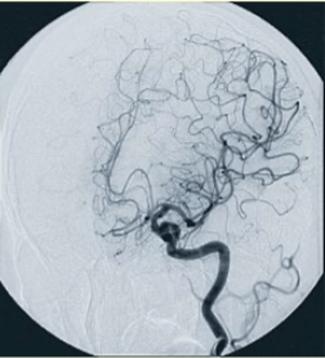 <p>A technique that requires a digital system to subtract bony and soft tissue anatomy from images, leaving only contrast-filled vessels.</p>