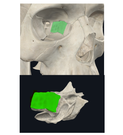 <p>Cara orbitaria del etmoides</p><ul><li><p>Lámina delgada y lisa, frágil como un PAPIRO!</p></li><li><p>Forma una gran parte de la pared medial de la órbita</p></li></ul><p></p>