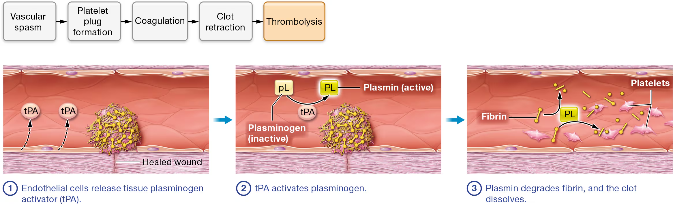 <p>once the wound is healed, the clot is no longer needed, so thrombolysis occurs.</p><p>begins with <strong><em>fibrinolysis</em></strong></p><p></p><p><strong>STEP 1:Endothelial cells release tissue plasminogen activator (tPA).</strong> Thrombolysis begins when healed endothelial cells produce and release the enzyme <strong>tissue plasminogen</strong> (<strong>plaz-</strong>MIN-oh-jen)<strong> activator, </strong>or<strong> tPA.</strong> Thrombolysis can also be initiated by a similar enzyme called <strong>urokinase</strong> (yoo-roh-KY-nayz), which is produced by cells of the kidney and found in the plasma and interstitial fluid.</p><p></p><p><strong>STEP 2:tPA activates plasminogen.</strong> The inactive enzyme <strong>plasminogen,</strong> which is normally found in plasma, has a high affinity for fibrin proteins and binds them as they are incorporated into the blood clot. As a result, every blood clot contains a significant amount of plasminogen. When tPA contacts plasminogen, it catalyzes the reaction that converts it to the active enzyme <strong>plasmin.</strong></p><p></p><p><strong>STEP 3:Plasmin degrades fibrin, and the clot dissolves.</strong> Plasmin catalyzes the reaction that degrades both fibrin and fibrinogen. This causes the remaining components of the clot to dissociate from the endothelium.</p>