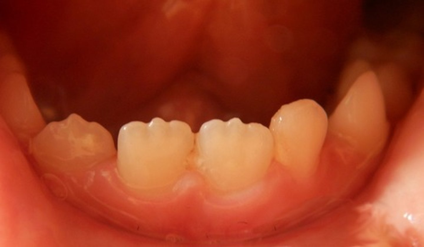 <p>_____ are rounded incisal extensions of the labial lobes found on newly erupted or unworn permanent incisor teeth.</p>