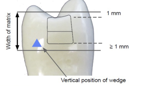 <p>must be at least 1 mm gingivally from gingival margin, 1 mm above the adjacent marginal ridge</p>