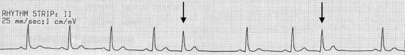 <p>HR:60-100 bpm</p><p>P-wave: absent</p><p>Regularity:Irregular</p><p>PR Interval:absent</p><p>QRS Duration: Normal</p><p></p>