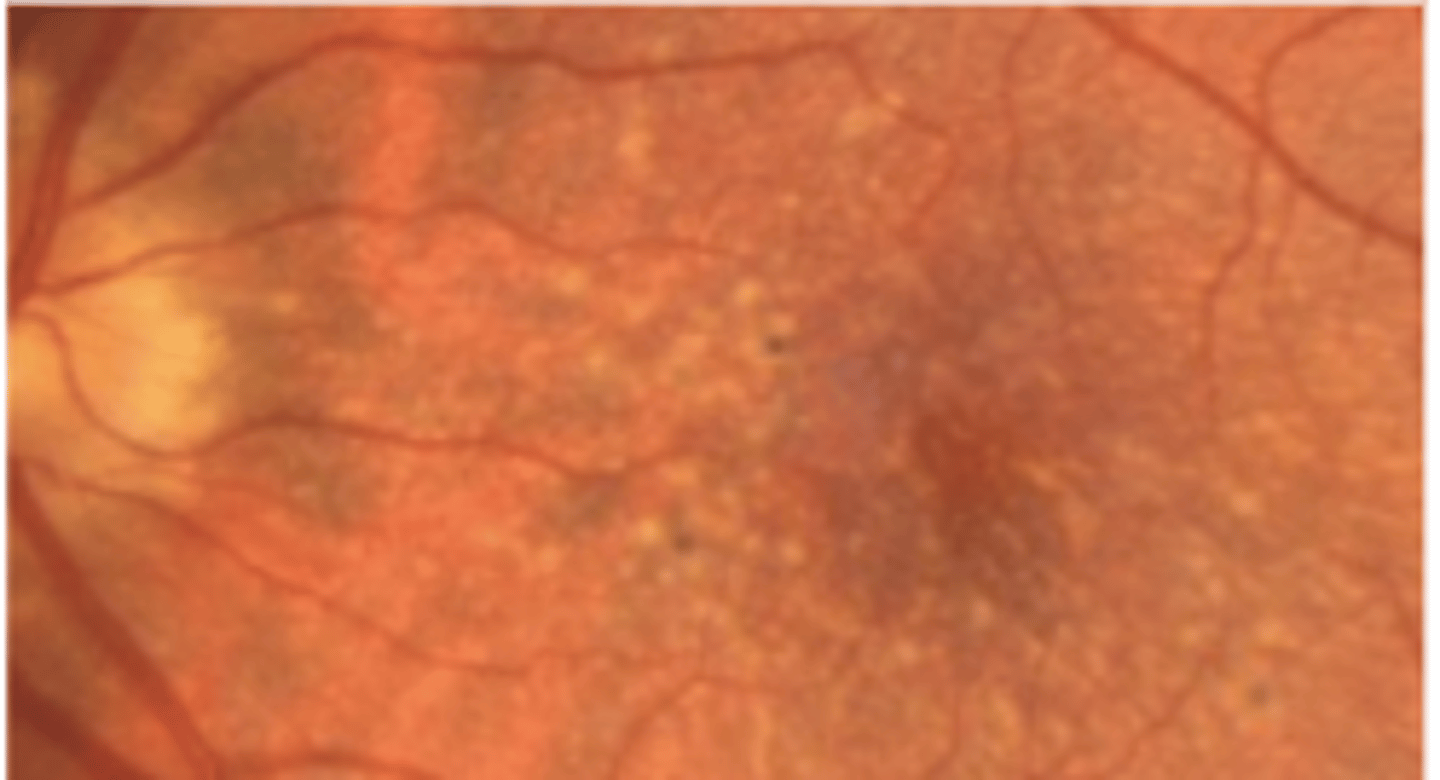<p>an autosomal dominant condition presenting as early as 15 yo, but typically in the 2nd-3rd decade. Is characterized by drusen scattered throughout the posterior pole which may result in RPE degeneration, macular atrophy, or CNVM. If macular involvment presents as scotomas, metamorphopsia, and decreased VA.</p>