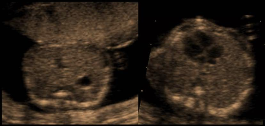 <p>a) the heart is abnormally small but the stomach appears normal </p><p>b) complete situs inversus</p><p>c) partial sinus inversus</p><p>d) normal 4 chamber heart + stomach </p>