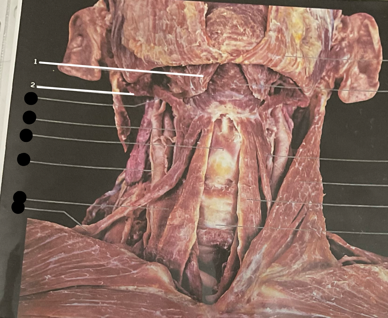 <p>#1 = anterior , #2 = posterior</p>