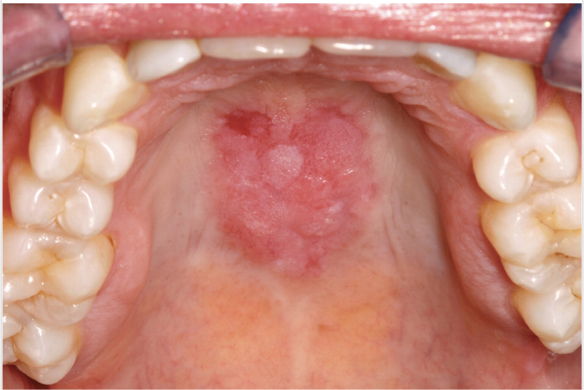 <p>Describe the Ulcers in Lupus</p>