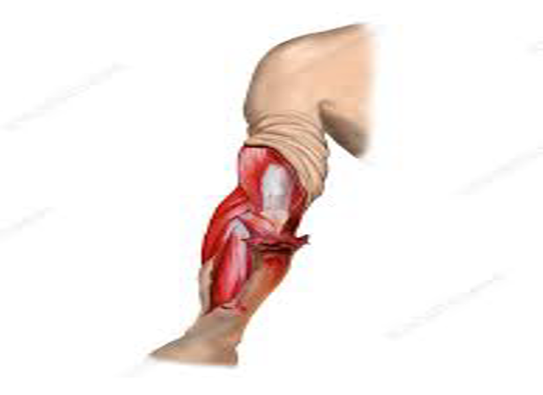 <p><span><span>Where a large piece of skin and underlying tissue is forcefully torn away.</span></span></p>