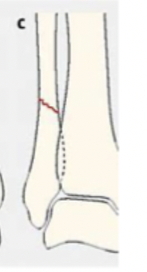 <p>Describe a Weber C</p>