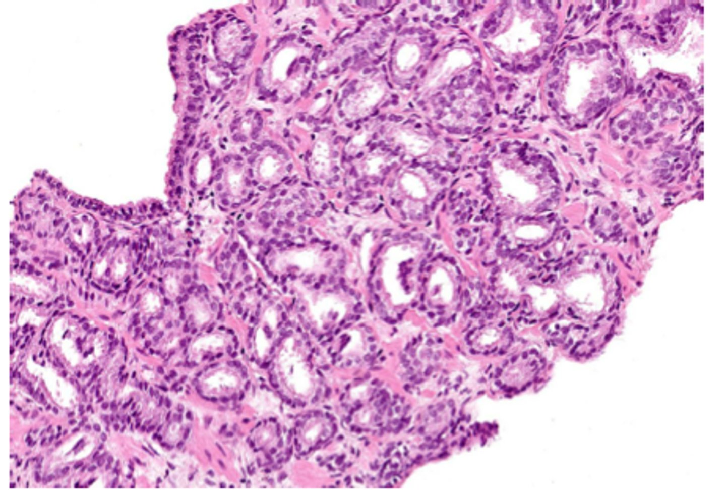 <p>cancerous tumor of glandular cells</p>