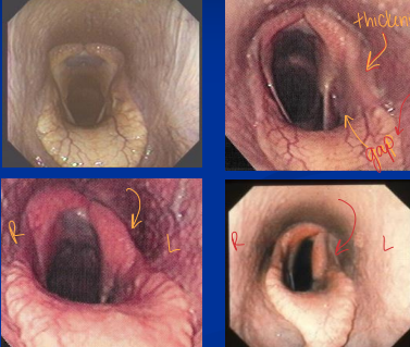 <ul><li><p><strong>Dynamic DDSP (soft palate)</strong></p><ul><li><p><span style="color: rgb(136, 136, 136);"><strong>Sig:</strong></span> <u>2-3y racehorses&nbsp;</u></p></li><li><p><span style="color: rgb(136, 136, 136);"><strong>Cs:</strong></span> <u>acute obstruction + “choking down ” at speed</u>,&nbsp;</p></li><li><p><span style="color: rgb(136, 136, 136);"><strong>Dt:</strong></span> treadmill/overground <u>endoscopy&nbsp;</u></p></li><li><p><span style="color: rgb(136, 136, 136);"><strong>Tx: </strong></span><u>fitness, tongue tie</u>, myotenectomy, partial staphylectomy</p></li></ul></li><li><p><strong>Left laryngeal hemiplegia (“roaring”)</strong></p><ul><li><p><span style="color: rgb(136, 136, 136);"><strong>Et:</strong></span><strong> </strong><u>left recurrent laryngeal nerve failure, QHs/Tbs/Drafts</u></p></li><li><p><span style="color: rgb(136, 136, 136);"><strong>Cs:</strong></span> inspiratory noise +<u> exercise intolerance&nbsp;</u></p></li><li><p><span style="color: rgb(136, 136, 136);"><strong>Dt: </strong></span><u>Endoscopy&nbsp;</u></p></li><li><p><span style="color: rgb(136, 136, 136);"><strong>Tx: </strong></span><u>prosthetic laryngoplasty “tieback” (</u>Good return to full performance)</p></li></ul></li><li><p><strong>Epiglottic entrapment</strong></p><ul><li><p><span style="color: rgb(136, 136, 136);"><strong>Et:</strong> </span><u>Epiglottis enveloped by aryepiglottic fold</u></p></li><li><p><span style="color: rgb(136, 136, 136);"><strong>Cs:</strong></span> <u>poor performance, noise,</u> cough, DDSP, <u>inflamed mucosa&nbsp;</u></p></li><li><p><strong>&nbsp;</strong><span style="color: rgb(136, 136, 136);"><strong>Dt:</strong> </span><u>endoscopy&nbsp;</u></p></li><li><p><span style="color: rgb(136, 136, 136);"><strong>Tx:</strong></span><strong> </strong><u>sx axial division of fold, anti-inflam sprays</u></p></li></ul></li></ul><img src="https://knowt-user-attachments.s3.amazonaws.com/631770d9-c313-4584-820d-b970e2a88134.png" data-width="25%" data-align="center"><ul><li><p><strong>Dynamic pharyngeal collapse</strong></p><ul><li><p><span style="color: rgb(136, 136, 136);"><strong>Et: </strong></span><u>High insp neg pressures, </u><strong><u>narrow pharynx</u></strong><u>, </u>neuropathy, fatigue, lymphoid hyperplasia, laryngeal hemiplegia, nasal obx</p></li></ul></li></ul><p></p>