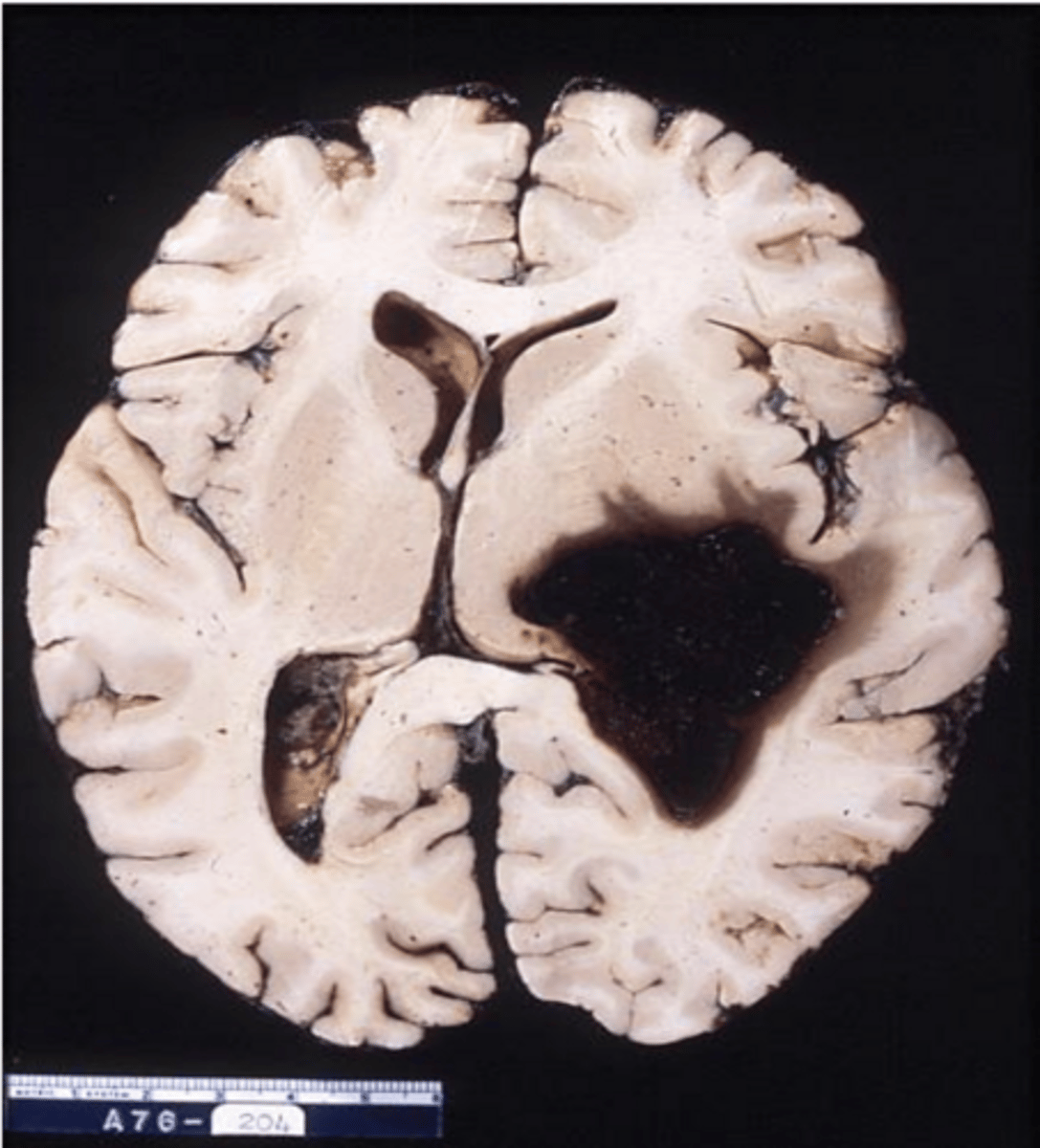 <p>What is the major cause of intracerebral hypertensive hemorrhage?</p>