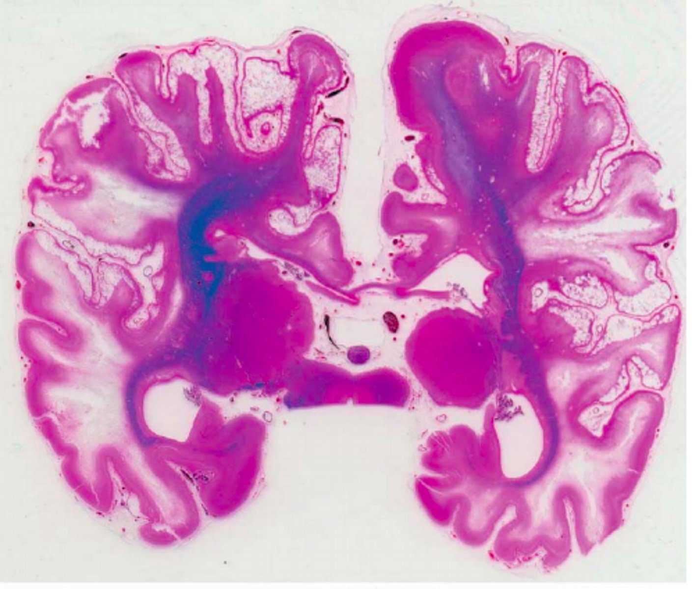 <p>What does PVL become when the condition progresses to being "widespread"?</p>
