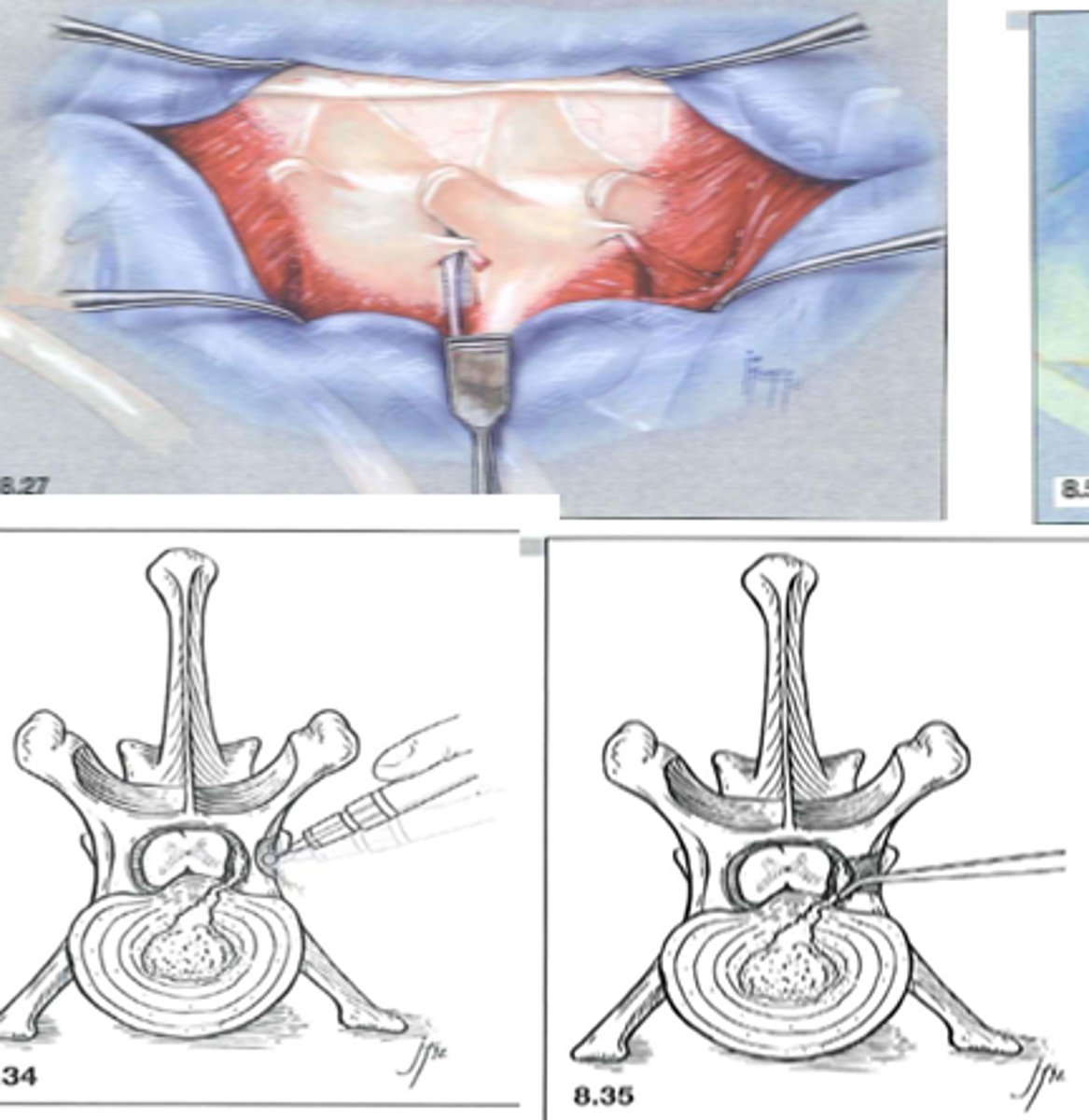 <p>Hemilaminectomy</p>