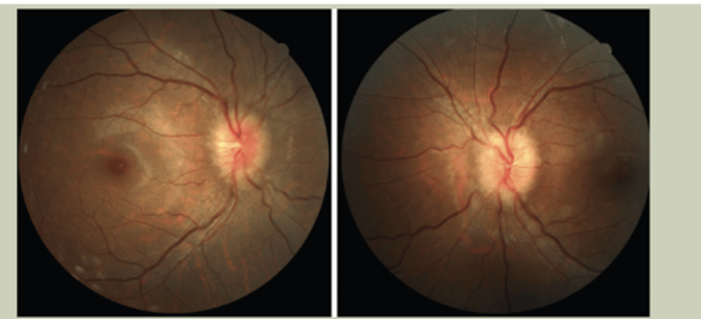 <p>-Bilateral Optic Nerve head swelling secondary to increased intracranial pressure</p><p>-SX: chronic headaches that worsen with postural changes, pulsatile tinnitus, dimming vision, horizontal diplopia</p><p>-Signs: Difficulty with looking to right &amp; left with H-motility test, bilateral swollen/elevated optic disc margins with DO</p><p>-Etiologies: Anything that occupies space within the cranium</p><p>-TX: EMERGENTLY to ECP/Ed</p>