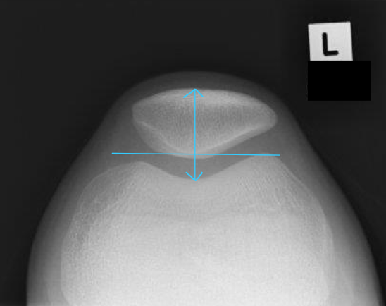 <p>lat fem con is slightly more ant to med.fem.con</p><p>ext.rot</p><ul><li><p>lat.con is aligned with the med.con</p></li></ul><p>int.rot</p><ul><li><p>med.con is ant to lat.con</p></li></ul><p></p>