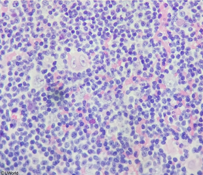 <p>60y man with 2 months fatigue &amp; 15lb unintentional weight loss over 6 months. temp 100.4, pulse 110, cervical &amp; axillary lymphadenopathy, pallor, hgb 9.5. </p><p></p><p>dx &amp; next step?</p><p></p>