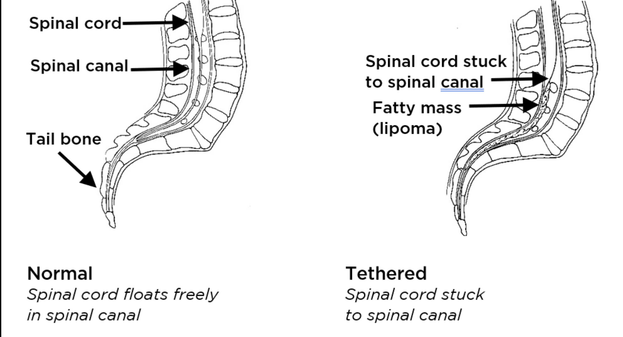 <ul><li><p>Define:</p><ul><li><p>Abnormal fixation of the SC/Dura</p></li></ul></li><li><p>Causes:</p><ul><li><p>Traction and Neurological Symptoms ESPECIALLy c Movement or Growth</p></li></ul></li></ul><p></p>