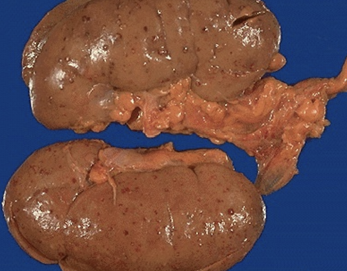 <p>Small abscess hematogenous spread shown in the image is from what underlying pathology?</p>