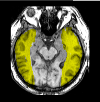 <p>What lobe of the brain is highlighted?</p>